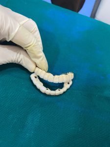 All on 4 implant