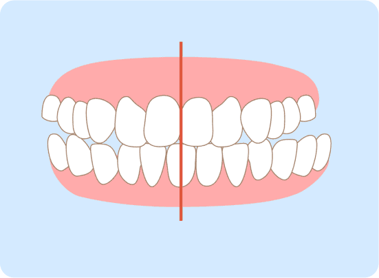 Misaligned Teeth