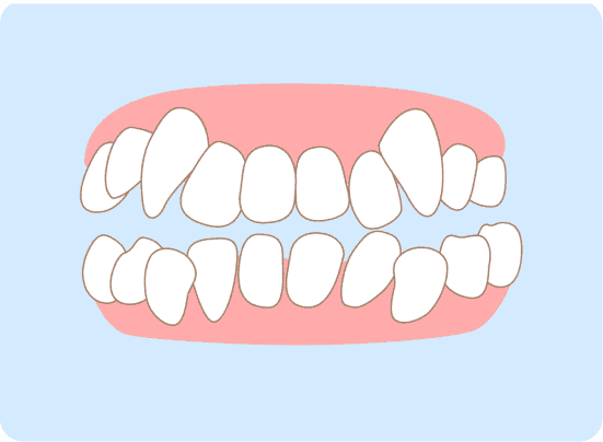 Misaligned Teeth