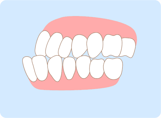 Misaligned Teeth