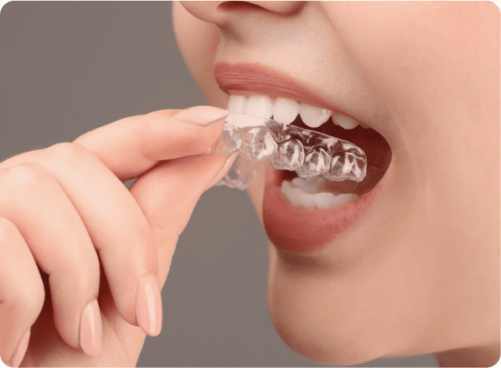 Invisible aligner - Dental Implant snd Smile Specialist Nagpur