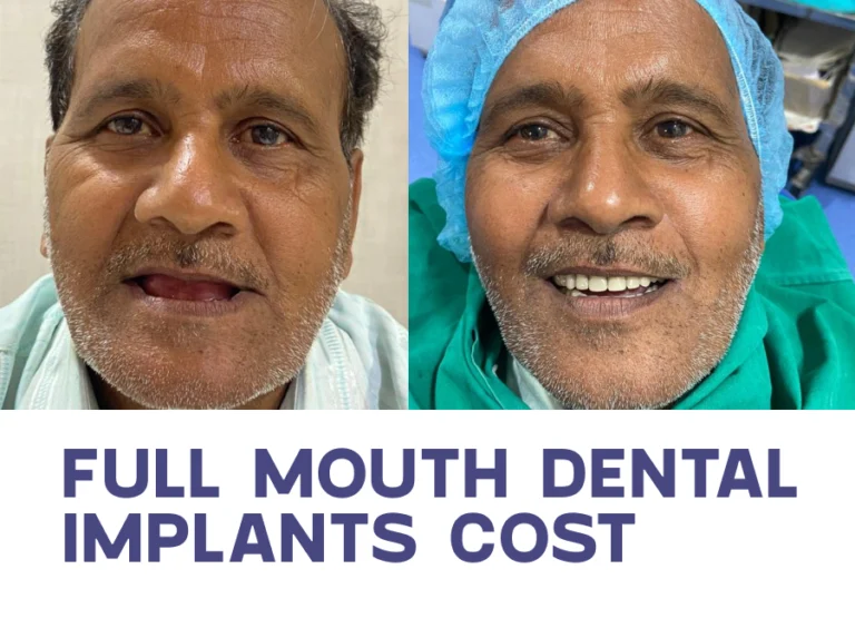 Full mouth dental implant cost in nagpur