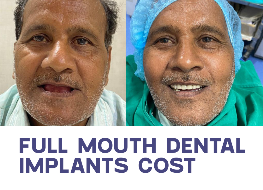 Full mouth dental implant cost in nagpur