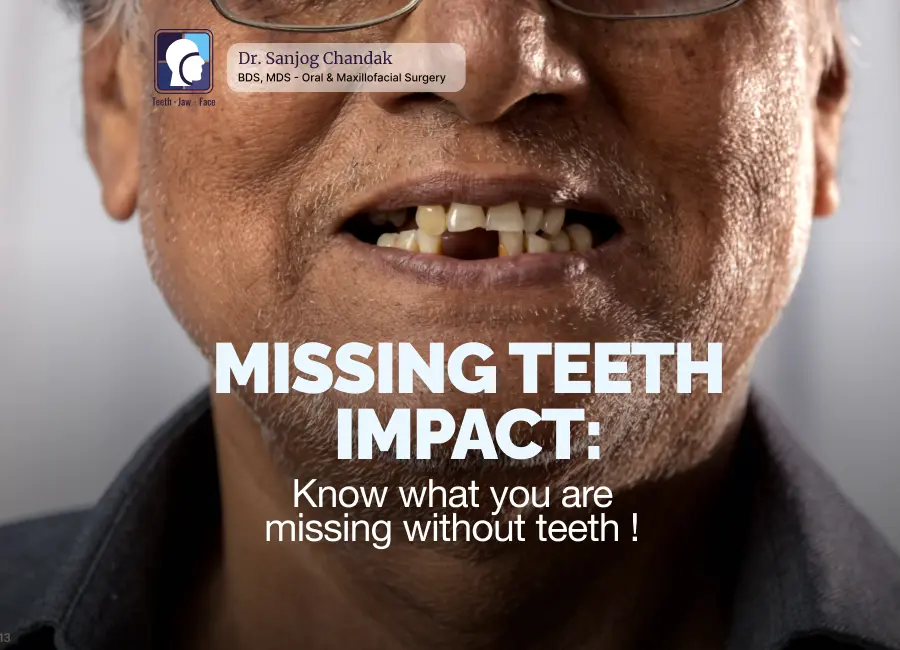 Impact of missing tooth- Dr Sanjog Chandak Nagpur