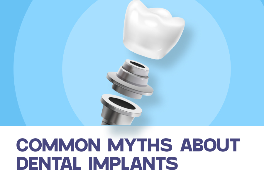 Common Myths about dental implants