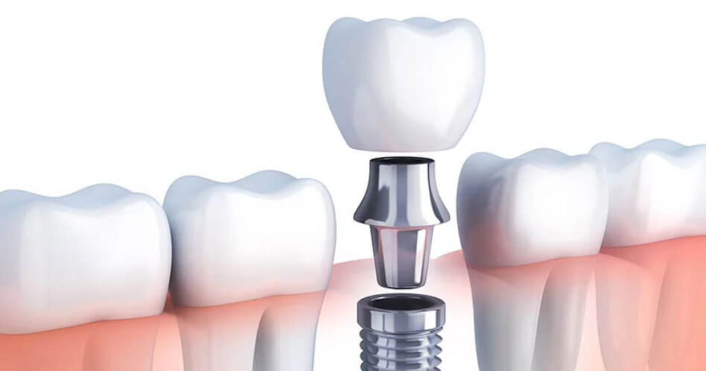 What is Dental implant?