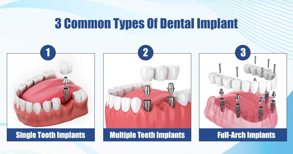 Types of dental implant