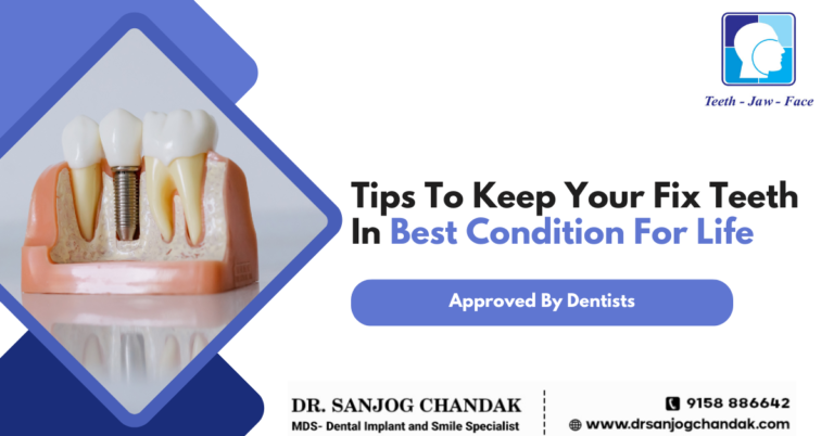 Tips To Maintain Dental Implant for life