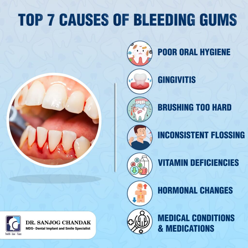 Causes of bleeding gums